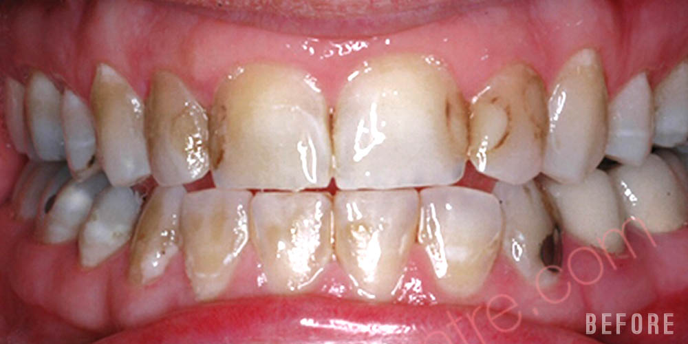 Dr-Johns-Dentistry-Services-IPS Express-Veneers